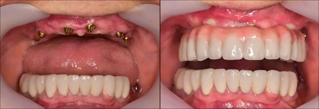 Prótese sobre Implantes